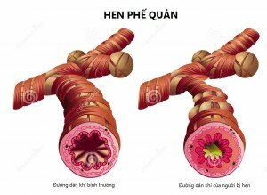 Cac-benh-ho-hap-thuong-gap-trong-mua-lanh