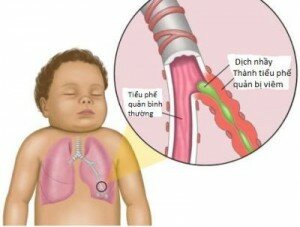 Cac-benh-ho-hap-thuong-gap-trong-mua-lanh2