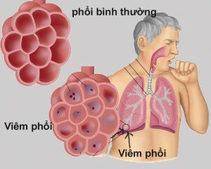 Cac-benh-ho-hap-thuong-gap-trong-mua-lanh3