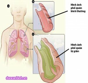 Cac-benh-ho-hap-thuong-gap-trong-mua-lanh4